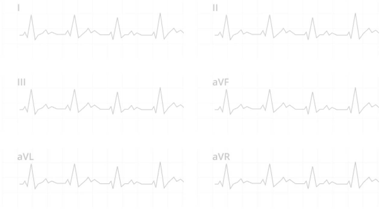 Teltohart 6-lead ECG derivations